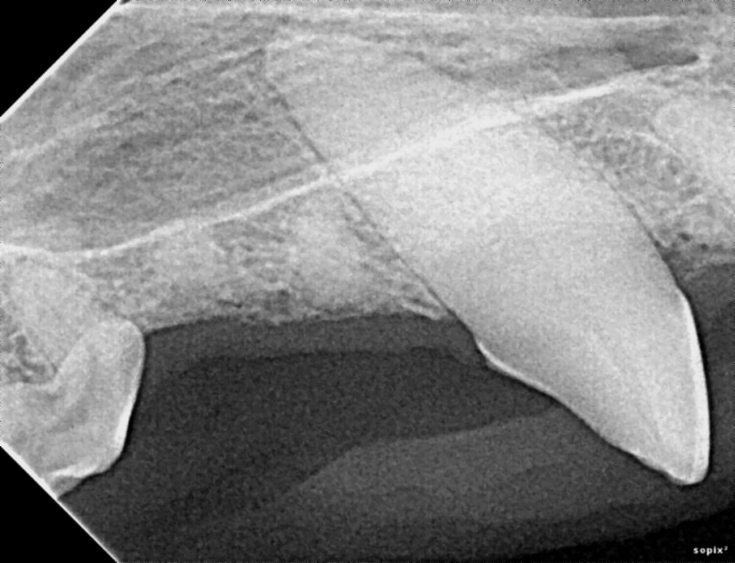 Dental X-Ray